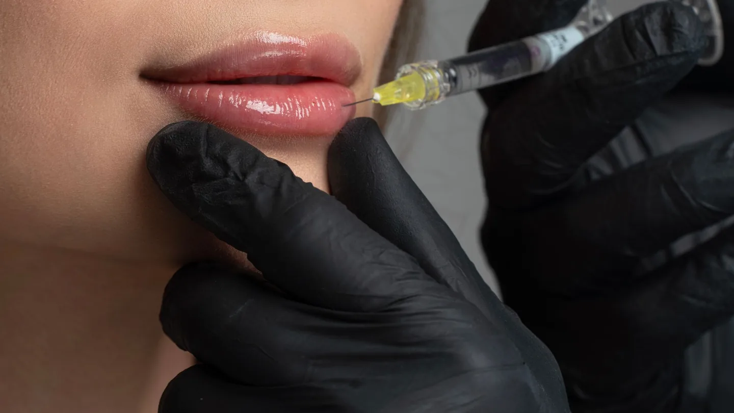 Hyaluron-Filler: Unterspritzung der Lippen
