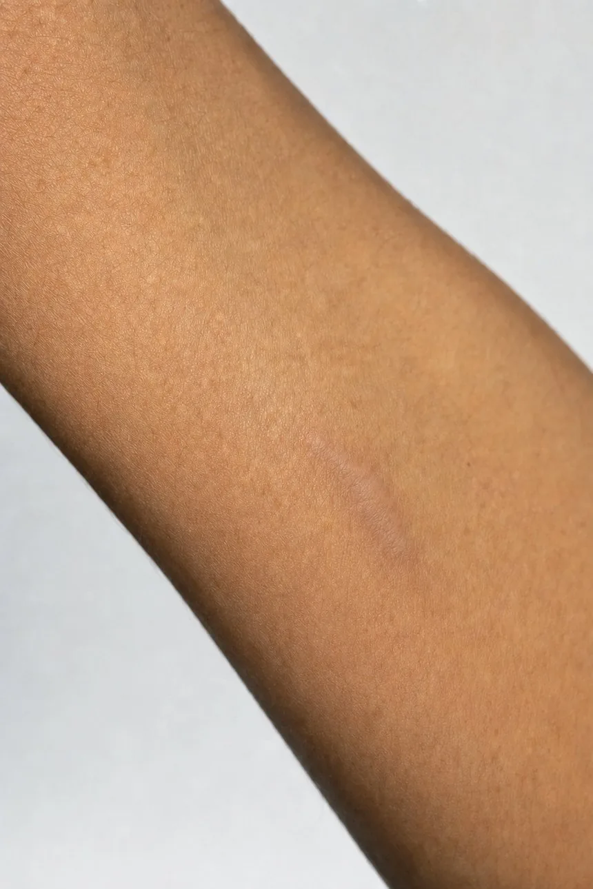 Nachher – Narbenbehandlung