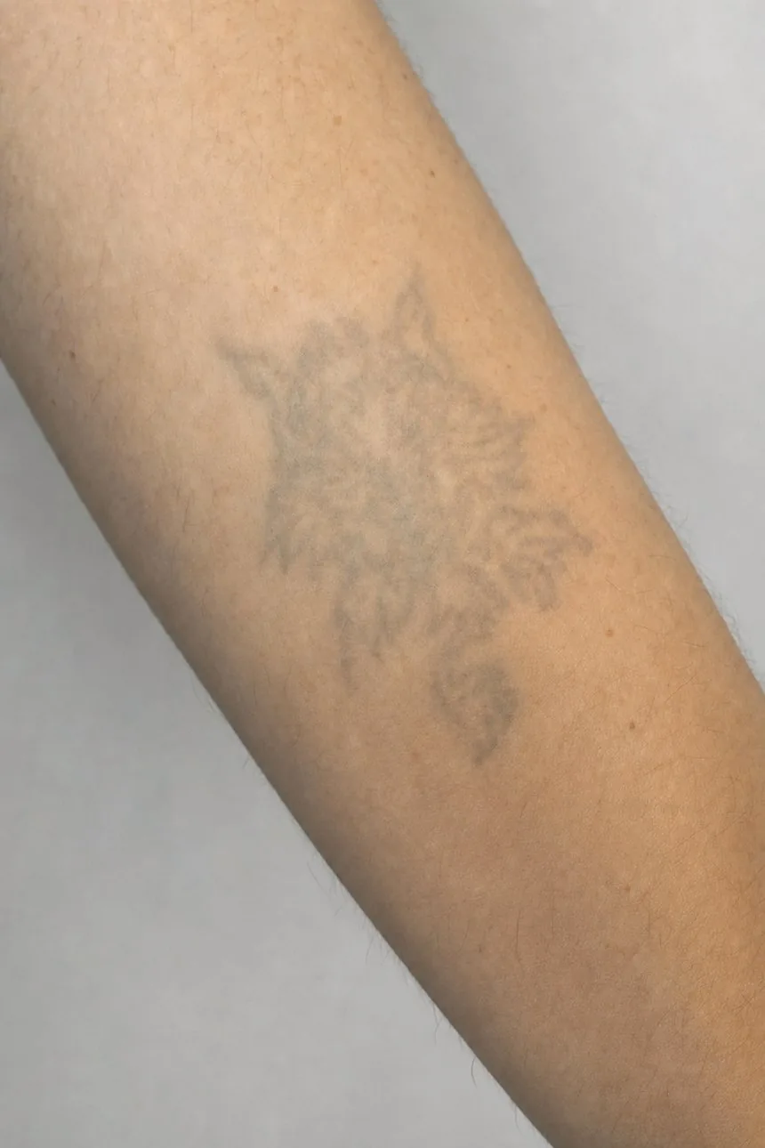 Nachher – Tattoo-Entfernung