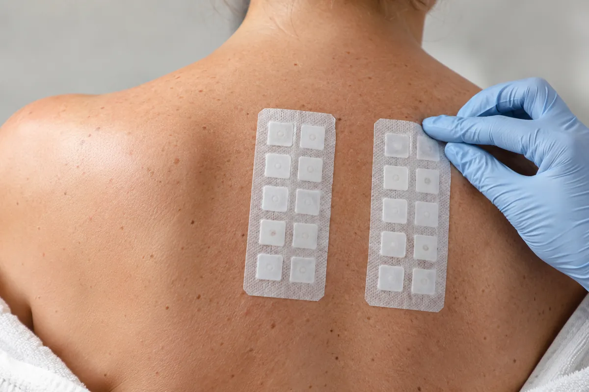 Epikutantest: Testpflaster mit Allergenkammern auf dem Rücken