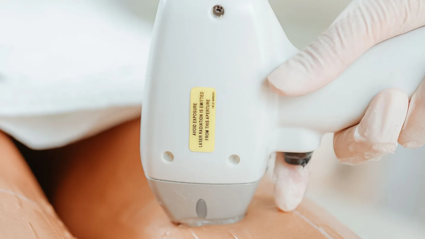Laserbehandlung von Besenreisern am Bein