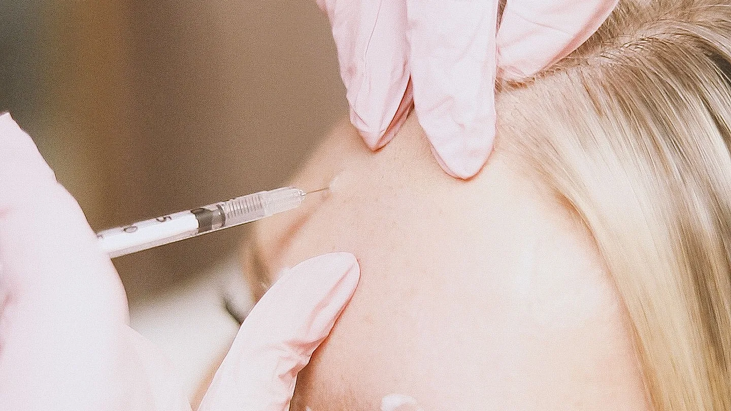 Faltenbehandlung mit Botulinumtoxin: Injektion im Stirnbereich