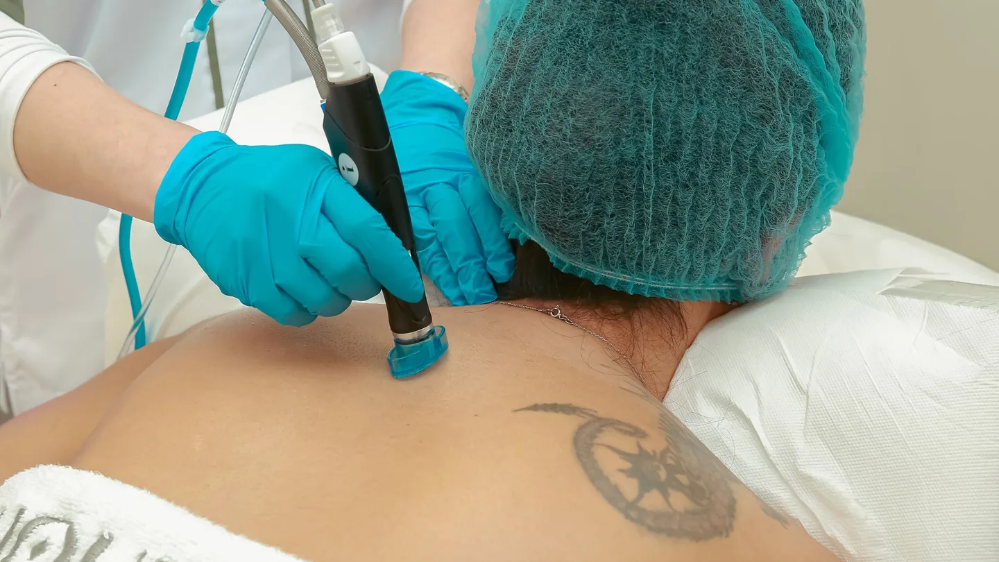 Laser-Tattooentfernung auf der Haut